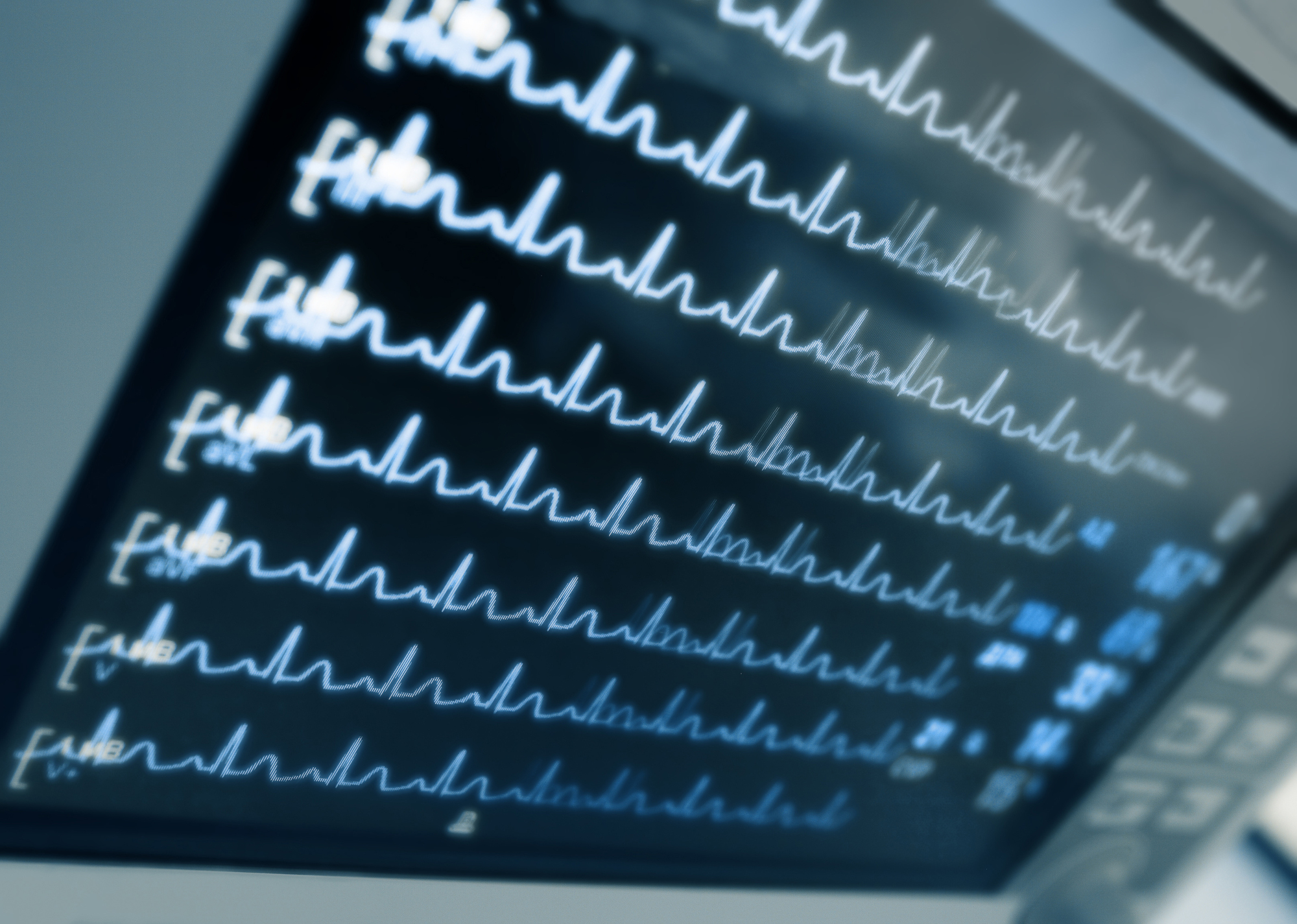 Medizinischer Monitor mit dargestellten Herzkurven und Vitaldaten